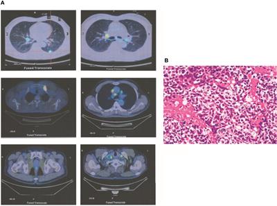 Case Report: Treatment of Alectinib in NSCLC With Brain Metastasis Patient Refractory to Radiotherapy After Resistance to Crizotinib